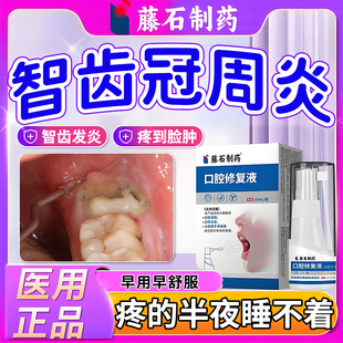 智齿冠周炎用专牙龈发炎肿胀牙齿疼痛面部水肿消炎用专喷雾剂YK
