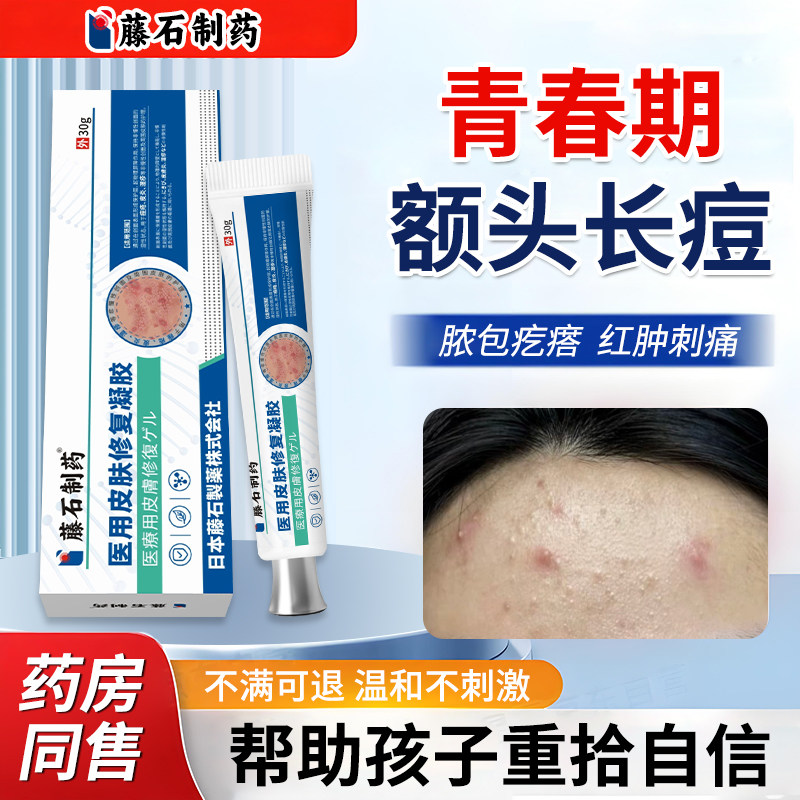 青少年青春期额头痘痘皮肤修复凝胶黑白头粉刺脓包疙瘩红肿刺痛YK