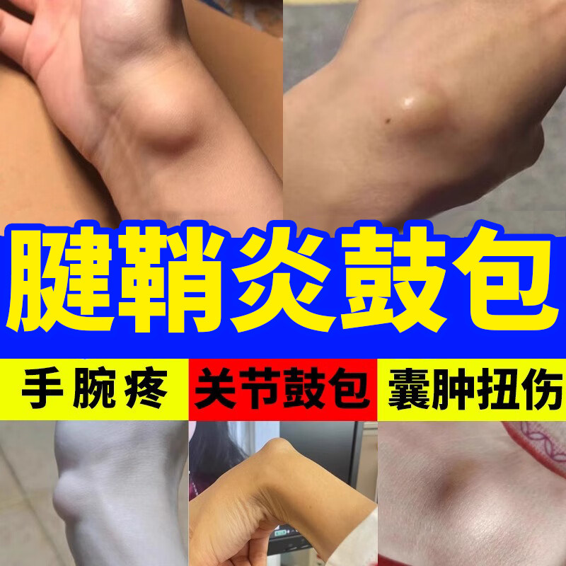 腱鞘囊肿鼓包贴手指关节肿疼痛屈伸困难大拇指弹响手腕鼓包积液AH