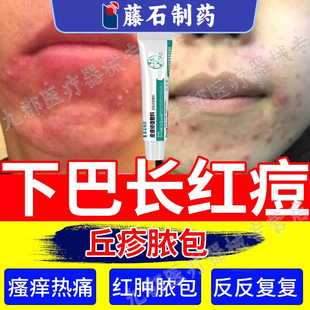 下巴长红痘痘丘疹脓包硬块座疮粉刺黄脓液红肿瘙痒膏药疼痛AH