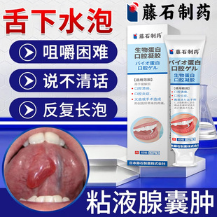舌根下唇肿水泡粘唾液腺囊肿口腔牙髓炎黏膜受损溃烂疡可搭药AH