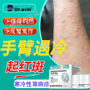 手臂遇冷起红斑寒冷性荨麻疹慢性药膏免疫力止皮肤瘙痒风团疙瘩YK
