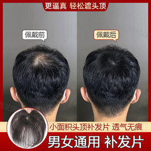 假发片男士头顶补发遮盖头旋发缝斑秃伤疤脱发稀少全真发女士可用