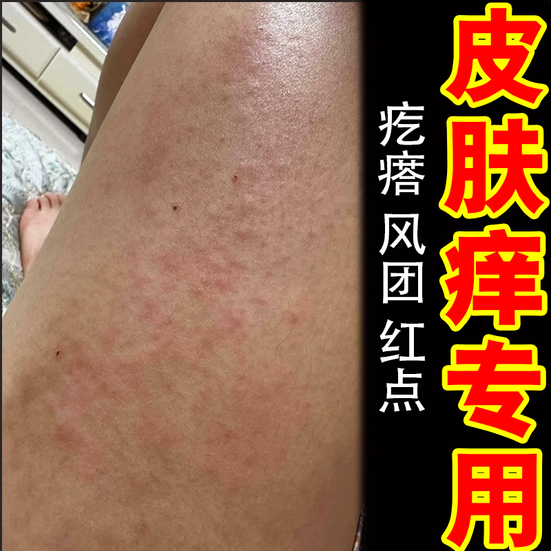 皮肤痒干燥粗糙全身干痒外用药乳