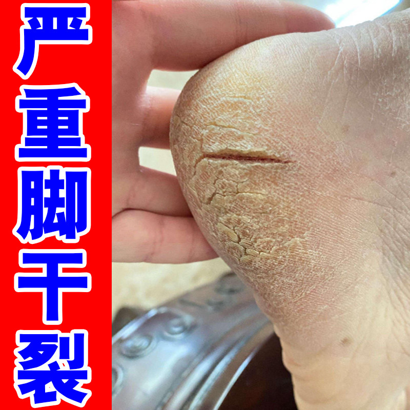 脚后跟干裂足跟开裂裂去死皮角质增厚手脚脱皮干裂修复