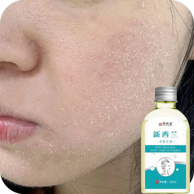 脸部干燥起皮掉皮脸爆皮起皮皮肤粗糙换季干燥季节性嘴周皮肤掉皮