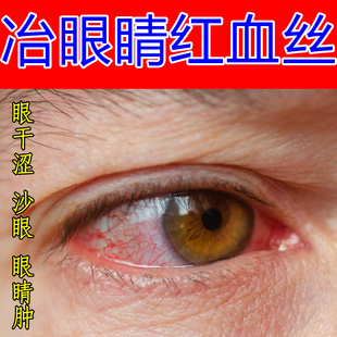冶眼睛红血丝眼发红干涩痒流泪眼疲劳眼里有异物黄视物模糊专用