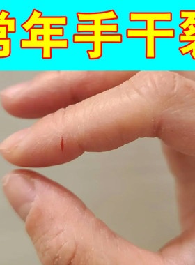 常年手干裂掉屑手部干燥痒角化型手指缝裂口子儿童手脱皮经常洗手