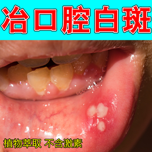 口腔白色念珠口腔菌唇舌黏膜白斑糜烂烧灼感口干扁平溃烂草本喷剂