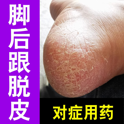 鳞屑角化型脚脚后跟增厚脱皮粗糙干裂痒脚死皮除