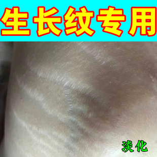 去肥胖纹修复霜生长纹消除学生大腿淡化妊娠纹精油祛紧致肚皮膏