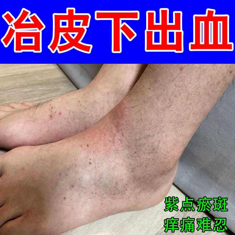 皮下出血腿上长红点过敏性紫点血斑瘀滞老年人腿上长红点紫点专用