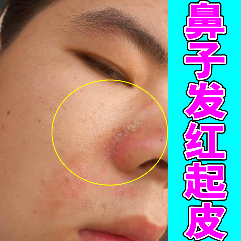 鼻子两边泛红鼻翼两侧发红干燥起皮鼻翼油腻脱皮掉皮脂溢性克星药