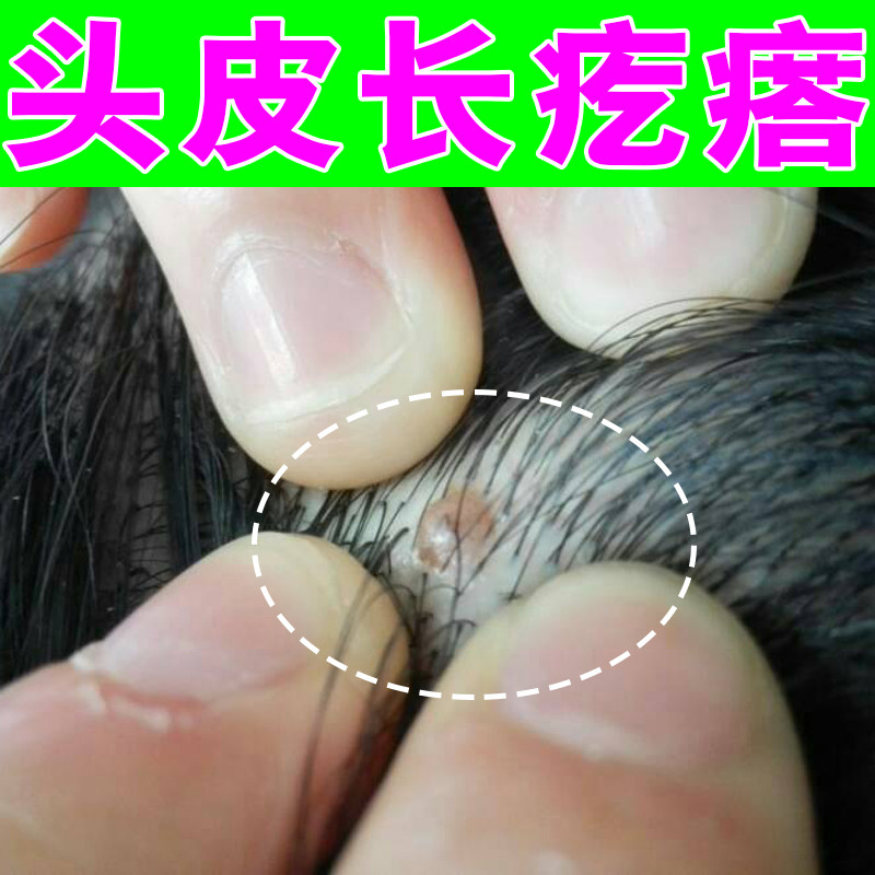 头皮长痘痘毛囊堵塞头上长疙瘩头发痒严重头皮屑痒除螨外用药霜