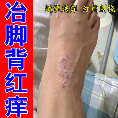 冶脚背红痒长红斑脚脱皮起红疹子鳞屑痒的抓出血刺挠一抓红一片痒