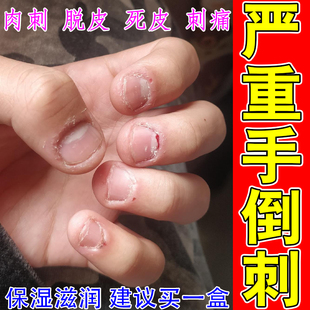 严重手倒刺儿童指甲边缘护甲油手指长肉刺干裂起皮修复神器药乳膏