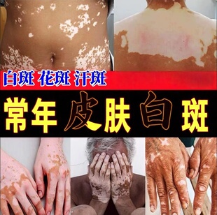 复方补骨脂酊白膏风快速消白专外用黑色素生长中成药偏方