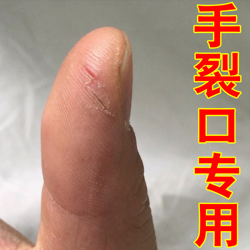 专冶手裂口手指头开裂脱皮手爆干皮手裂口子粗糙修复药乳