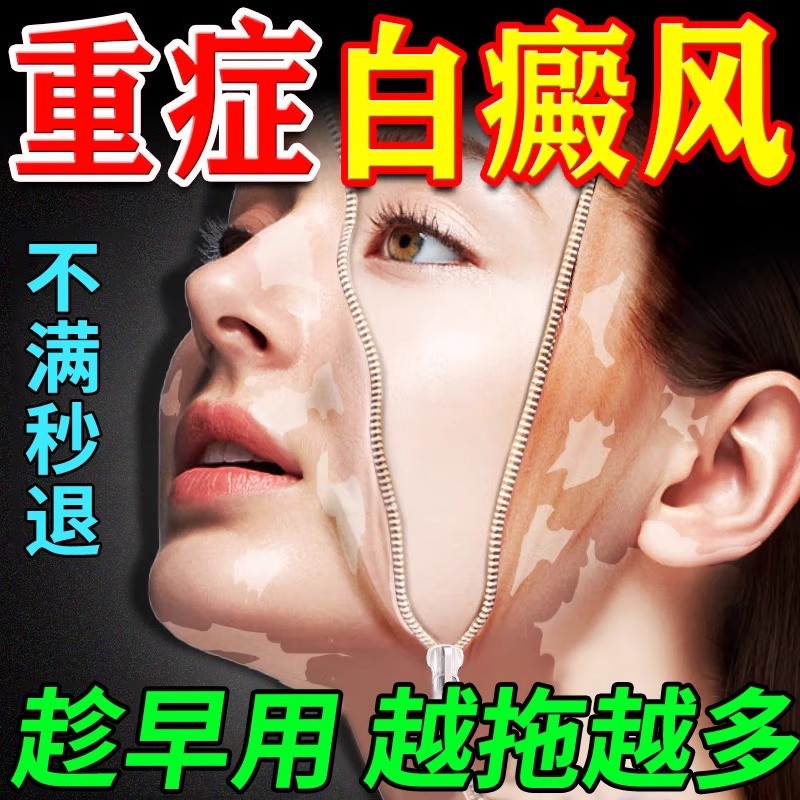 白癜风特效药皮肤白斑色素脱失促进黑色素生长快速消白斑专用膏