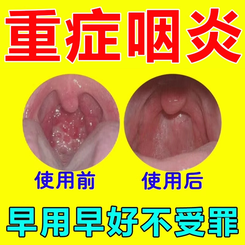 咽喉炎慢性咽炎除根喷雾剂药治喉咙滤泡增生润烟喉糖异物感贴专用