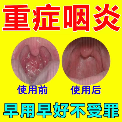 咽喉炎慢性咽炎除根喷雾剂药治喉咙滤泡增生润烟喉糖异物感贴专用