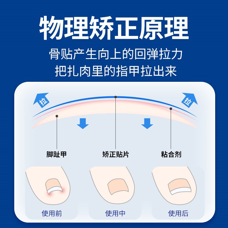 德国钛合金弹片甲沟嵌甲矫正器正甲贴脚趾L指甲往肉里长专用神器