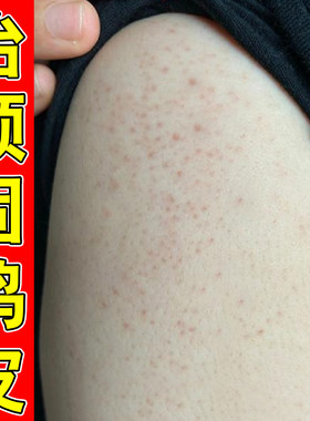 手臂鸡皮疙瘩毛囊毛周角化去除胳膊腿上黑点角质毛孔堵塞专用