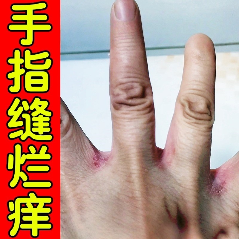 手指缝溃烂痒膏药手指脱皮发痒干燥烂手丫真菌感染糜烂专用修复膏