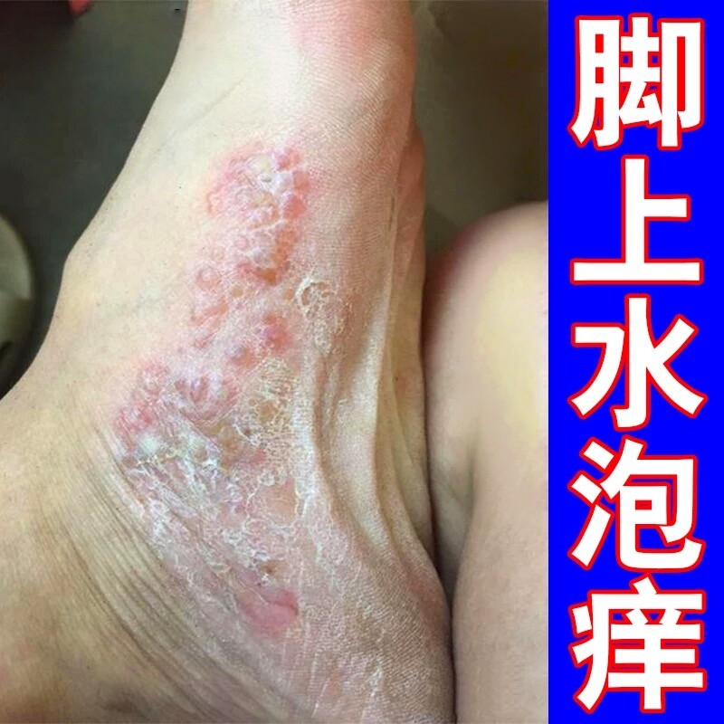 脚底上起小水泡又痒又脱皮脚痒脚皮肤消毒护理（消）