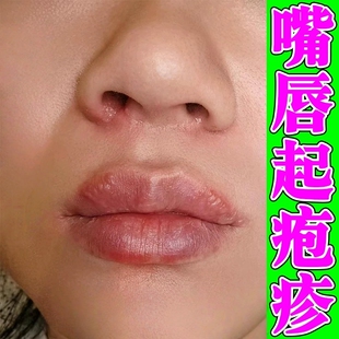 嘴唇疱疹上火起水泡烂嘴角专用药膏口角炎痒嘴巴干裂脱皮红肿修复