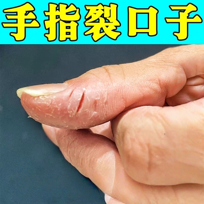 手指头裂口子干裂修复霜秋冬季手掌干燥脱皮开裂疼痛防裂修复乳膏