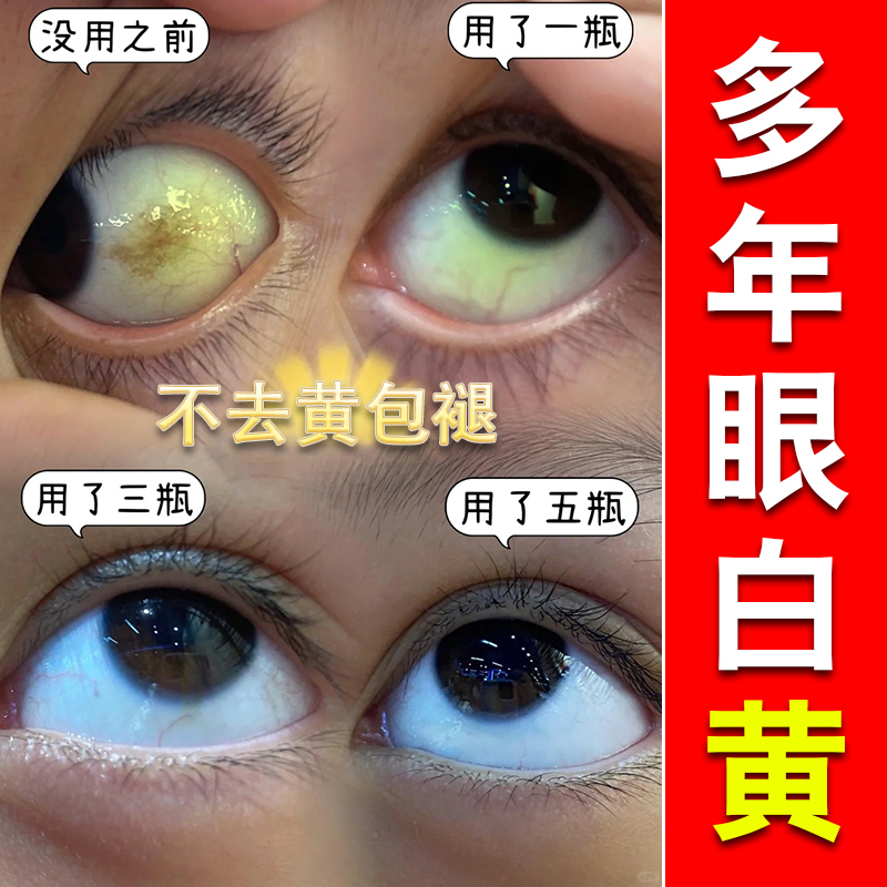 眼白发黄眼睛清澈去黄红血丝滴眼液黄斑病变抗疲劳干涩模糊眼药水