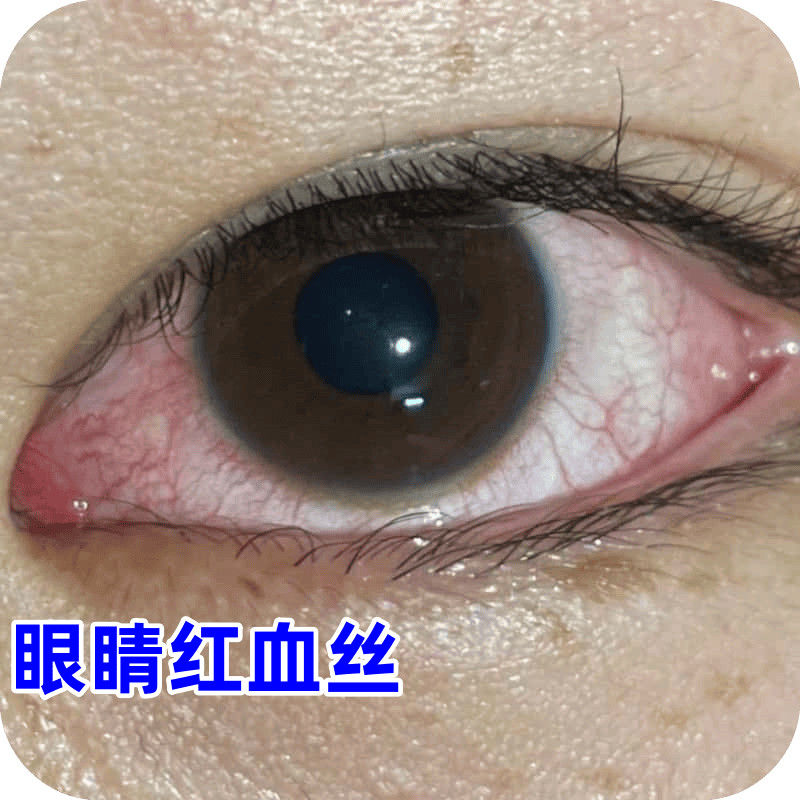 眼睛红血丝眼白发红结膜充血干涩疲劳发红流泪熬夜眼红正品眼液