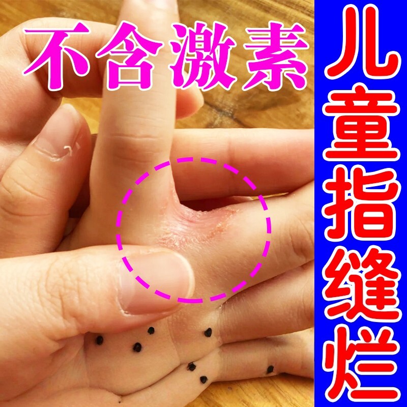 儿童手指缝溃烂膏药手指脱皮发痒感染指间干燥起皮开裂掉皮修复膏