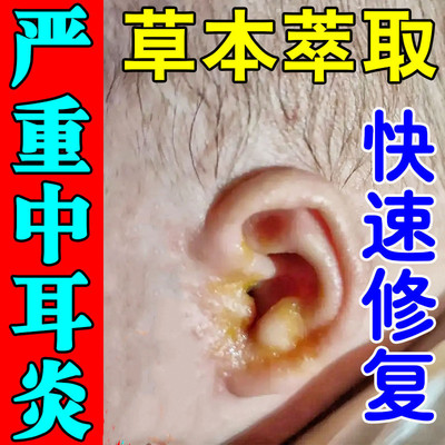 中耳炎滴耳液人用专治耳朵痒发炎流水流脓耳屎软化耳道痒修复软膏