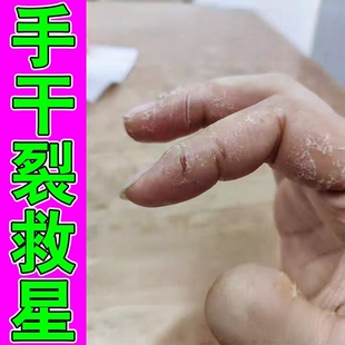 冬天手指裂口子干裂修复霜儿童指尖开裂干燥粗糙脱皮真菌感染药膏