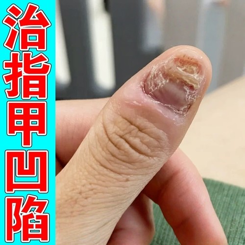 指甲盖凹凸不平修复液受损再生甲板变软下陷真菌感染营养油液