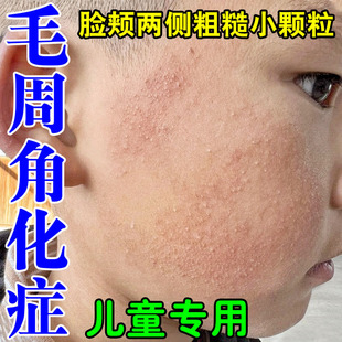 儿童脸上有小颗粒脸部起小疙瘩脸颊两边长痘鸡皮疙瘩闭口粉刺瘙痒