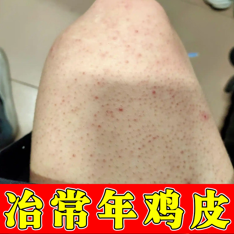 腿上小颗粒去腿部鸡皮毛囊小红点皮肤消毒护理（消）