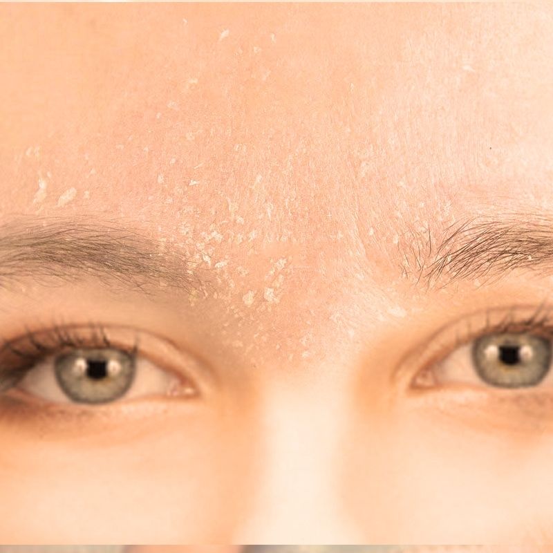 脸上起皮干皮脸干痒脸上脱皮掉皮皮肤泛红刺痛秋冬季皮肤干燥发痒