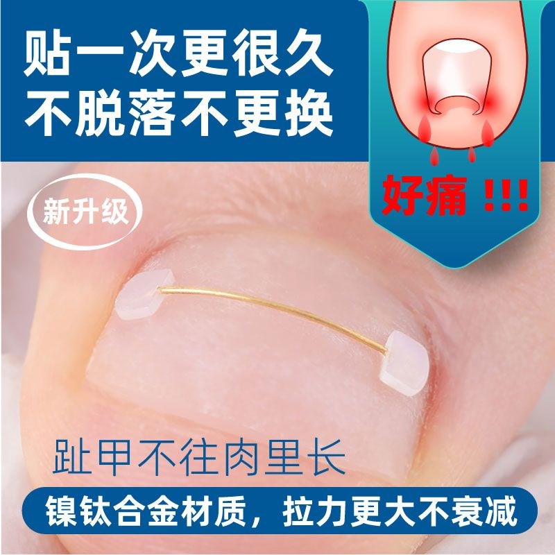 速发医生沟甲 嵌甲记忆钢肉 矫正器正甲贴片脚趾甲指甲扎丝炎