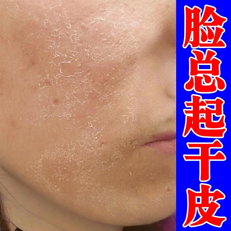 脸上干燥起皮过敏皮肤修复脸部红痒脱皮掉皮屑滋润面部爆干皮红肿