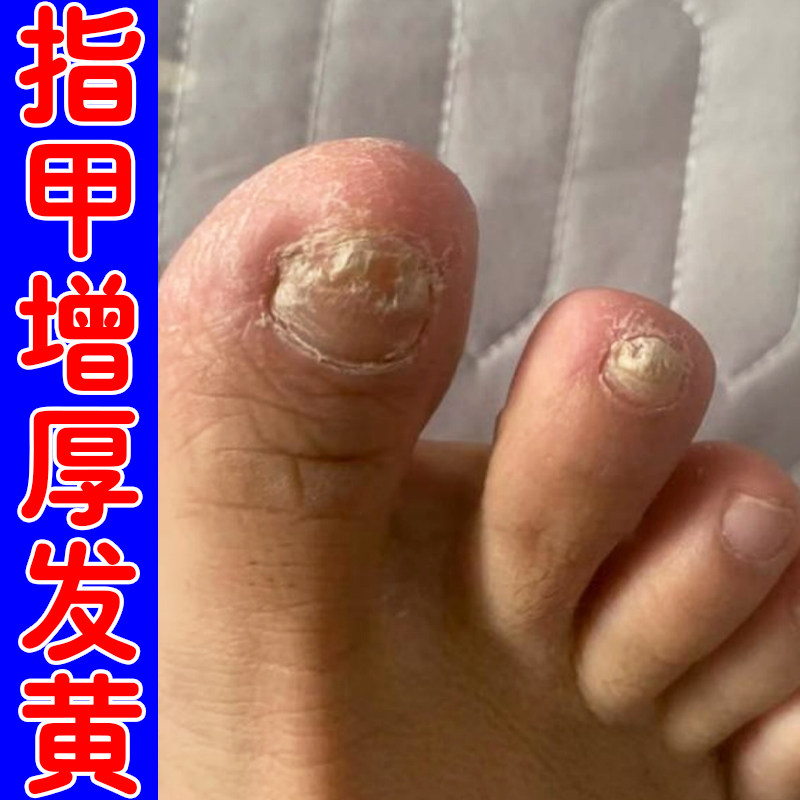 脚指甲变厚变硬发黄增厚变空真菌手脚空指甲的药手甲床分离修复液
