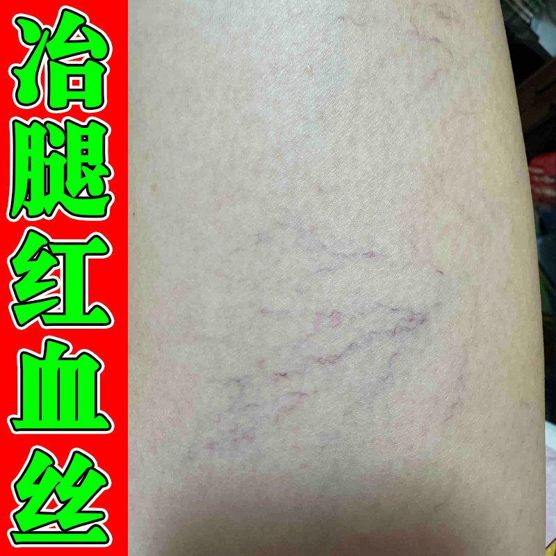 腿上有红血丝腿部青筋凸起缓解毛细血管扩张下肢血管堵塞外用软膏