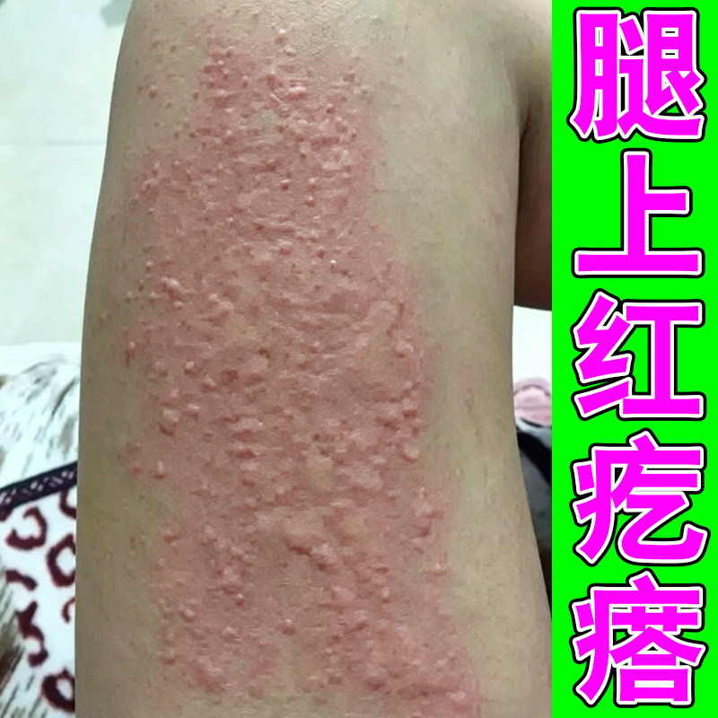 腿上红疙瘩皮肤痒风团红斑过敏身皮肤消毒护理（消）