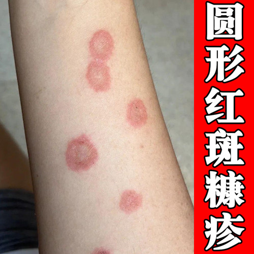 手臂圆形红斑感染过敏皮肤玫瑰糠疹干燥粗糙痒外用修复药