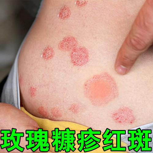 玫瑰糠疹红斑鳞屑感染过敏日光性紫外线晒伤皮肤痒专用软膏