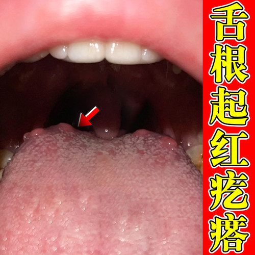 舌根起红疙瘩小肉球吞咽有异物感咽喉滤泡喉咙红点修复喷雾剂