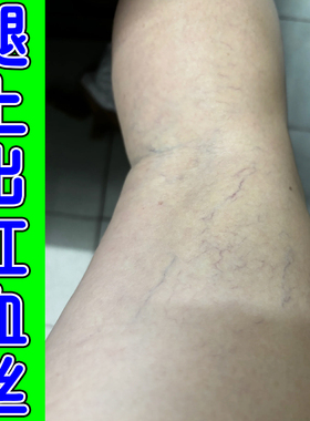 腿上有红血丝冷敷凝胶男女下肢血管堵塞肿胀毛细血管扩张