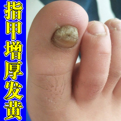 脚指甲发黄变厚增厚变硬修复真菌坏甲甲床分离脱落脚指甲